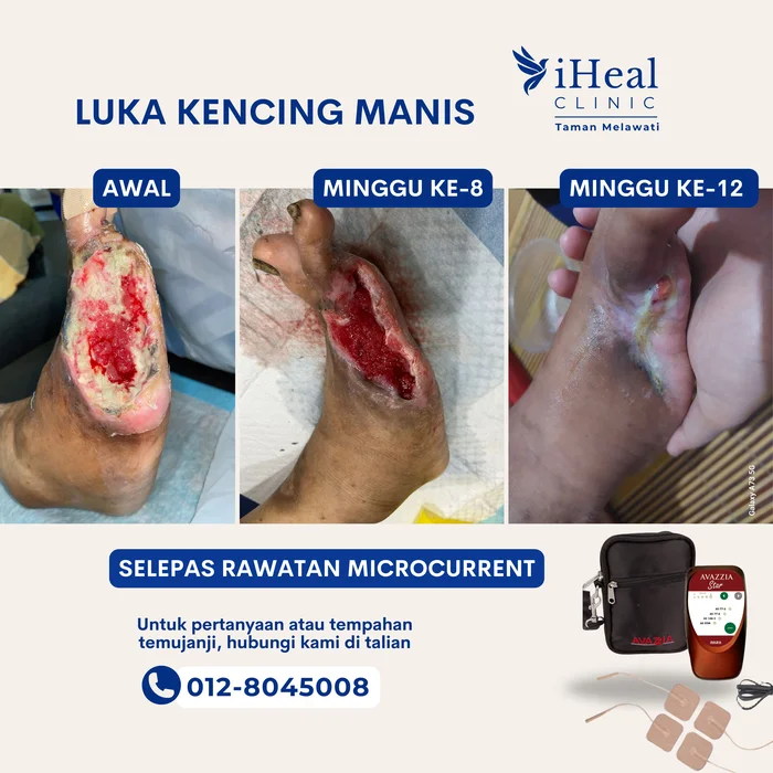 cuci-luka-microcurrent-therapy