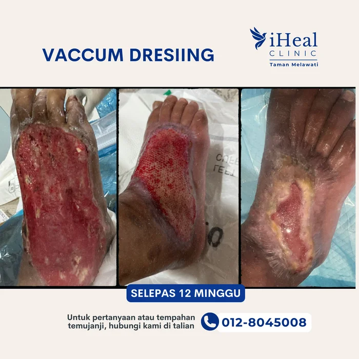 klinik-cuci-luka-vacuum-dressing