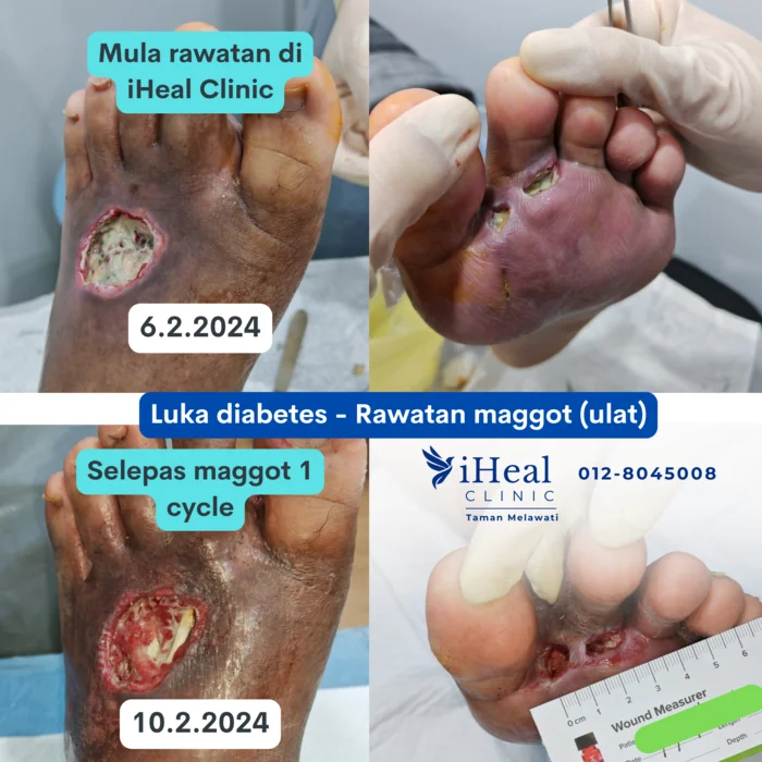 klinik-cuci-luka-maggot-therapy