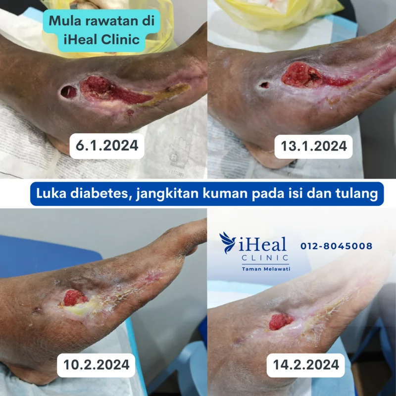 luka-diabetes