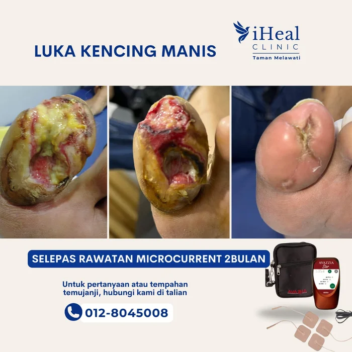 klinik-cuci-luka-microcurrent-therapy
