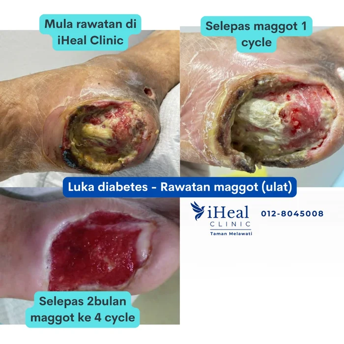 klinik-cuci-luka-diabetes-maggot
