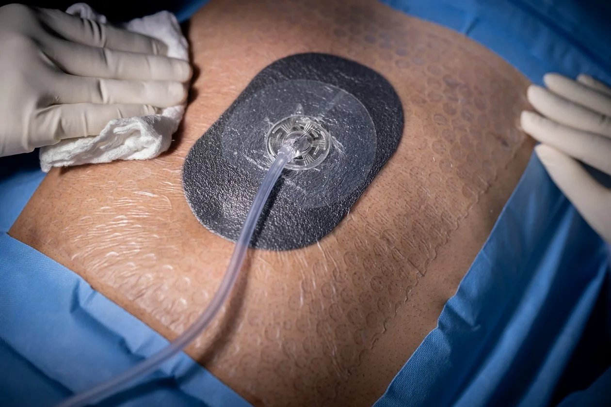 klinik-cuci-luka-vacuum-dressing